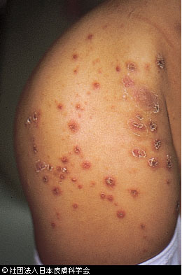とびひ 伝染性膿痂疹 の特徴や治療について解説 コドモの大学