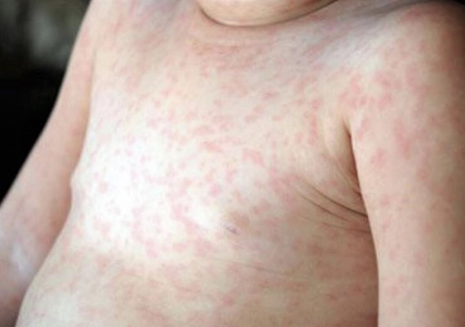 発熱や発疹の対処法